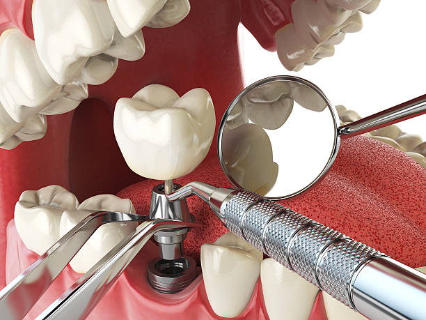 Best Emergency Wisdom Teeth Removal in North Baltimore, OH